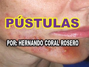 PÚSTULAS - LLAGAS DE PUS EN LA PIEL