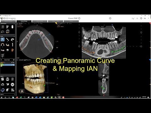 CS 3D Imaging Version 3.10.12 - Implant Planning Part 1 Panoramic Curve and Nerve Mapping