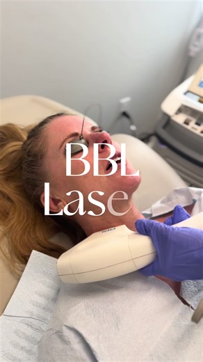 Skin tighting, Pigmentation and redness all treated in one treatment