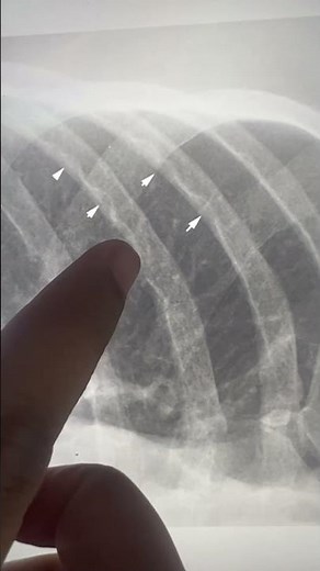 Inferior rib notching | Coartication of Aorta #radiologyresident
