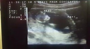 83K views · 583 reactions | 10 week old baby moving in the womb #beautiful #humanity ❤ | Precious Life | Facebook