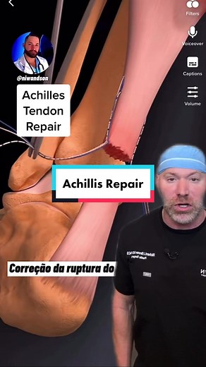 Achilles tendon rupture #brownsanatomy @MoverMatt | achilles tendon snap