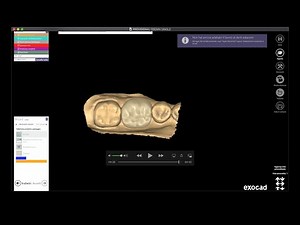Exocad 5 minutes guide - Provisional Single crown - Corona singola provvisoria