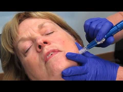 Skin Pen (Microneedling)