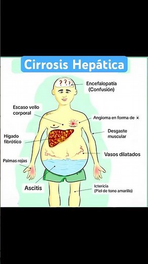 Algunos signos y síntomas de la cirrosos hepática #medicina #enfermeria #semiologia #cirrosis