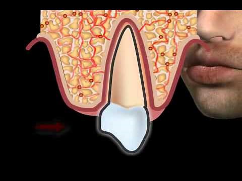 What are Receding Gums?