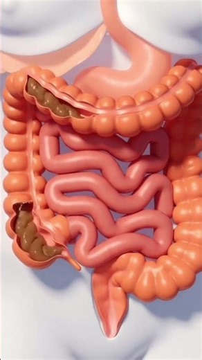 3D Animation of Constipation Explained | Gut Health l sss
