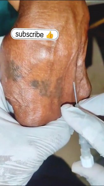 24G Yellow Cannula Insertion 💉 | Perfect Blood Flashback 🩸 #Shorts #trending #hospital