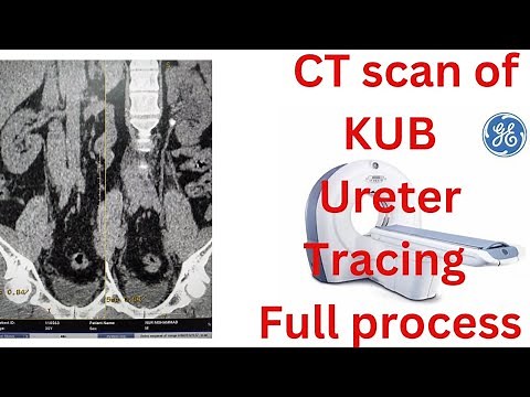 CT scan KUB Ureter tracing process ###
