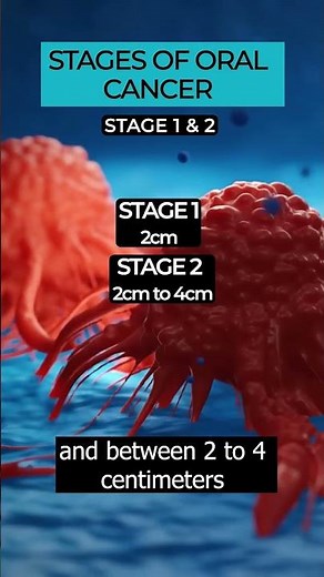 Understanding the Stages of Oral Cancer: Diagnosis and Treatment 🎗️👄 #OralCancer #cancerstages