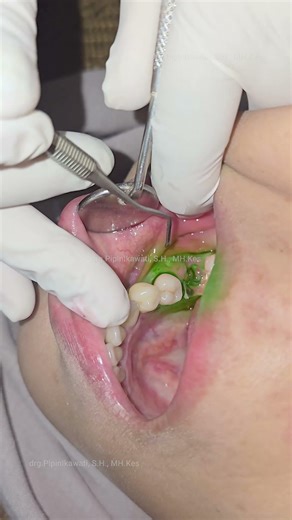 Swollen and painful gums, molars removed || PART 1 OF 3