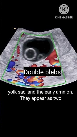 Double bleb sign on ultrasound #radiology #ultrasound #pregnant #baby