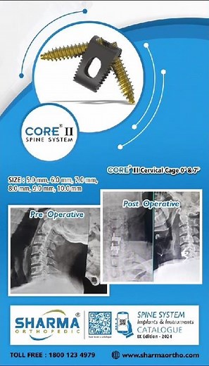 CORE® II Cervical Cage 0° & 7°👆🏻| Sharma orthopedic