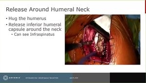 Glenoid Exposure Tips: Incision, Insertion, Releasing, and Retracting