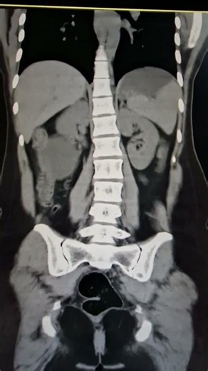 CT Scan of Abdomen