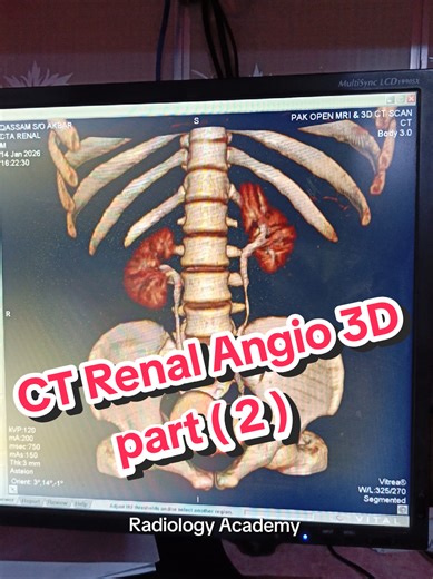 CT Renal Angiography 3D Techniques Explained