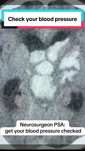 Uncontrolled high blood pressure silently weakens brain arteries. When they rupture, the bleeding in the brain leads to damage that is often permanent. Chronically elevated blood pressure could be silent and the first symptom could be a brain bleed. #doctor #bloodpressure #medial #science #fyp | Dr.Z Neurosurgery