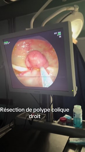 Résection de polype colique droit : Tout savoir