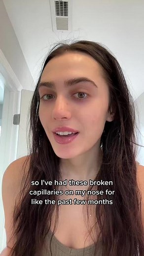 Effective Broken Capillaries Treatment with High Frequency Wand