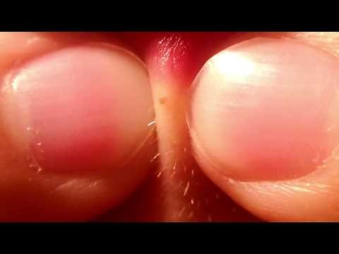 Lip Blackhead Removal