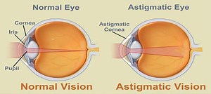 What is Astigmatism - Causes, Symptoms,Treatment
