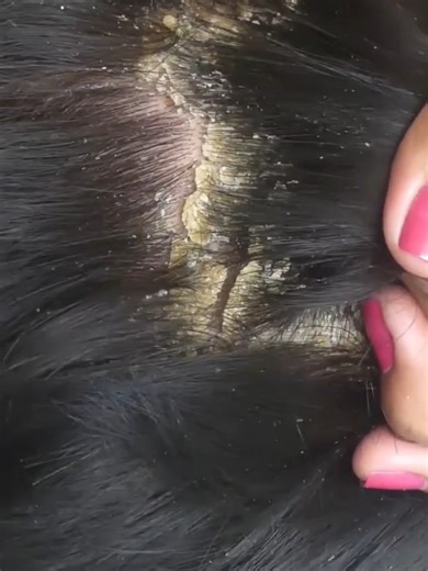 33K views · 170 reactions | Dandruff dreams floating in midnight air. | Flake Lab | Facebook