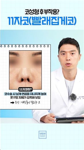 [코성형] 11자코는 재수술 각? 어떻게 교정할까?