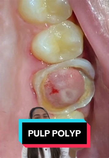 Pulp Polyp 🦷✨ | pulp polyp sa ngipin