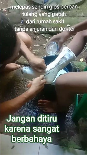 Is it permissible to remove a cast from a fractured bone without advice from an orthopedic doctor...