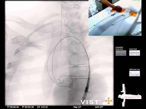 Mentice - Thoracic Endovascular Aortic Repair (TEVAR) Case Video
