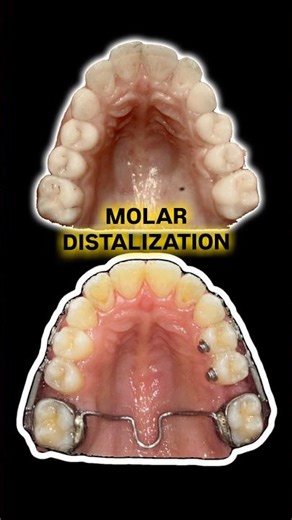 Proclined front teeth? Missing 2nd molars? Upper molar distalization with TAD for indirect anchorage