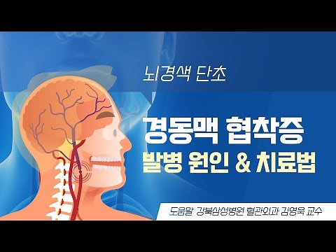 [애니헬스] 뇌경색 단초 ‘경동맥 협착증’ 발병 원인 & 치료법