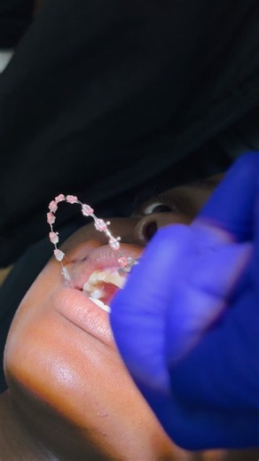 Braces Removal Debonding Day: What to Expect After Braces