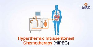 HIPEC - Chemotherapy redefined