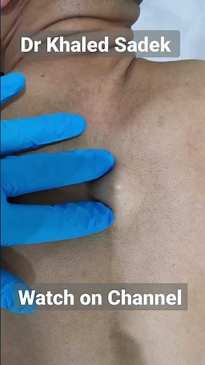 Juicy back cyst. Dr Khaled Sadek. LipomaCyst.com