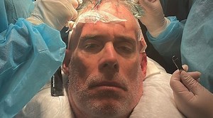 Joe Buck Shows Off His Latest Hair Plug Procedure