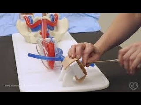 Alternative Strategies for Challenges in Veno Arterial ECMO Cannulation 03 1