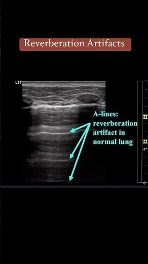 Ultrasound physics- Reverberation Artifacts