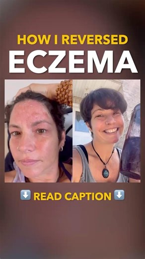 How I Reversed Eczema