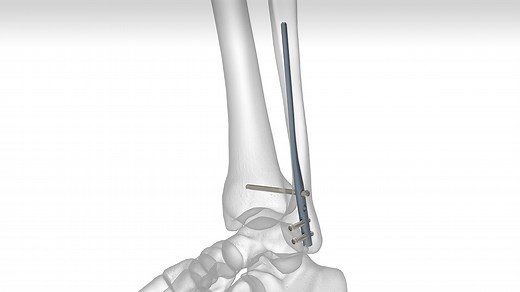 Fibula Rod System