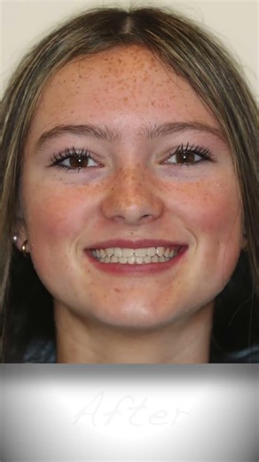 Before & After of an Underbite Braces Treatment