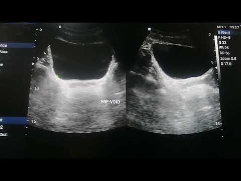 Normal Appearance of Urinary Bladder on Ultrasound and Calculating pre-void and Post - Void Volume.