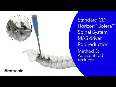 CD Horizon™ Solera™ Spinal System + Dual Rod Multi-Axial Screw (DRMAS) & Variable Angle Domino (VAD)