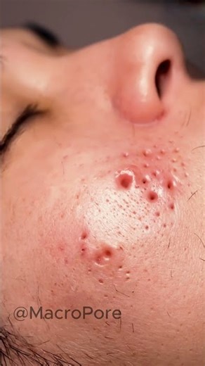 ONE PASS — MULTIPLE PUSTULES GONE 👃 #asmrshorts