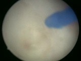 Holmium Laser Enucleation of Prostate HoLEP with Anatomical Bladder Neck Dissection • Video • MEDtube.net