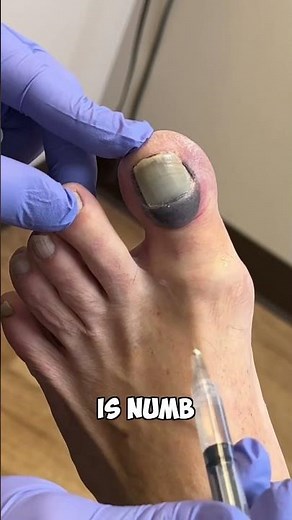 Ouch! Numbing A Toe: A Quick Fix"