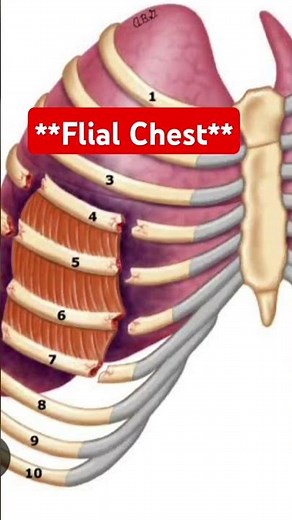 Flail chest // Paradoxical movement. # nursing image based // Ribs fracture.