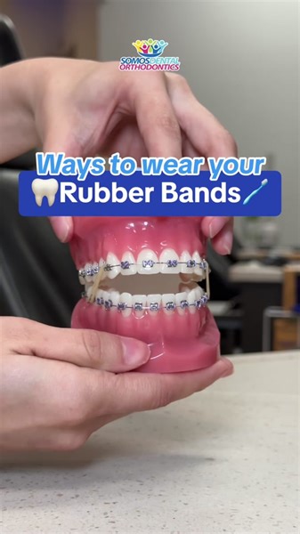 Ever wondered what Rubber Bands help to modify when you have Braces? 🦷🪥 #dental #rubberbands #teeth #braces #arizona #phoenix #smile #perfectteeth #bracescheck