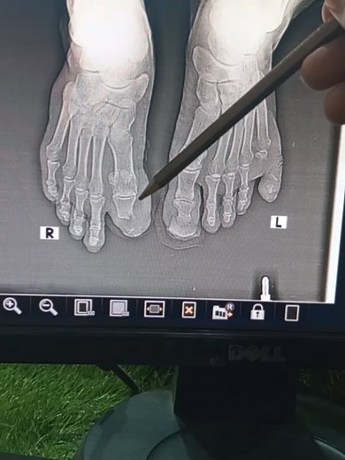Phalanges Amputation in Diabetes Patients Explained