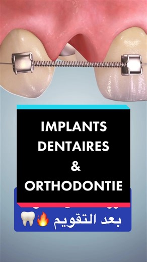 زراعة الأسنان بمساعدة التقويم - Creation d’espace Orthodontique pour implant dentaire #agadir #dentiste #implant #dentist #maroc